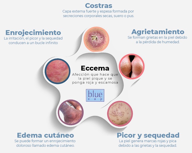 Understanding Eczema