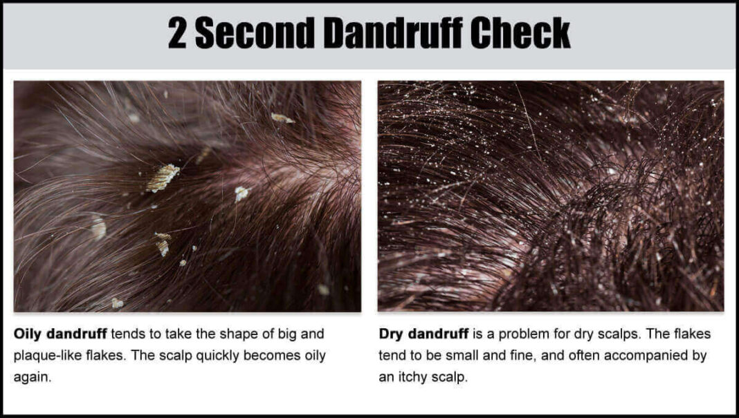 Is Dandruff Contagious