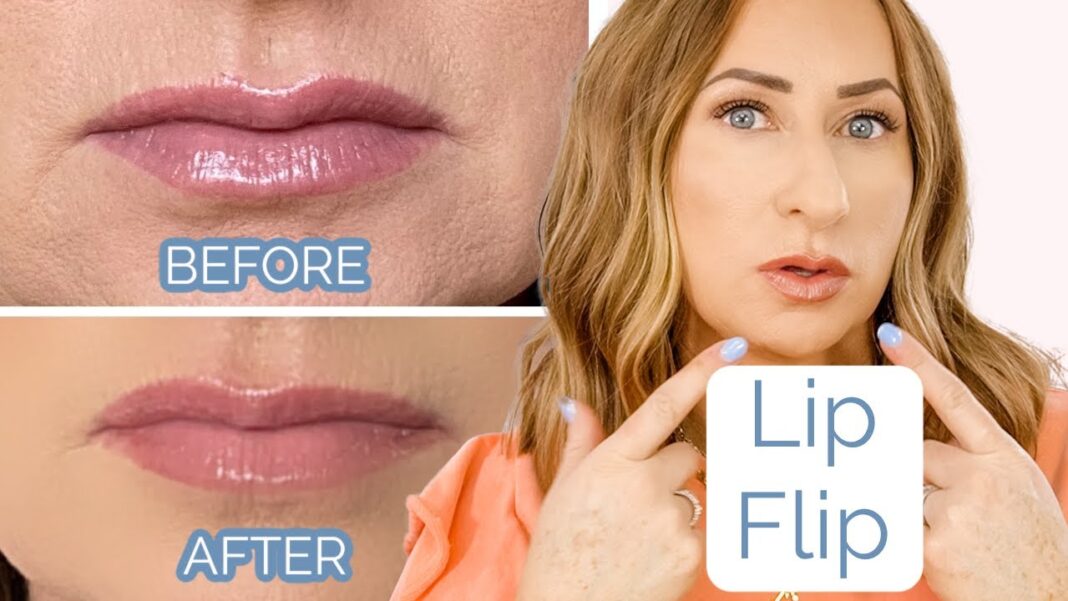 Lip flip before and after