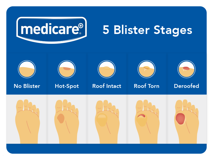 Diabetic Foot Blister