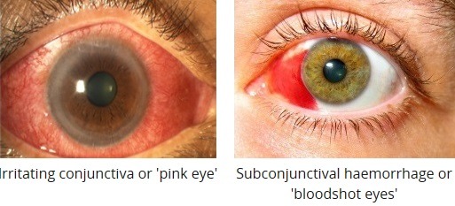 Pink eye vs. Red eye