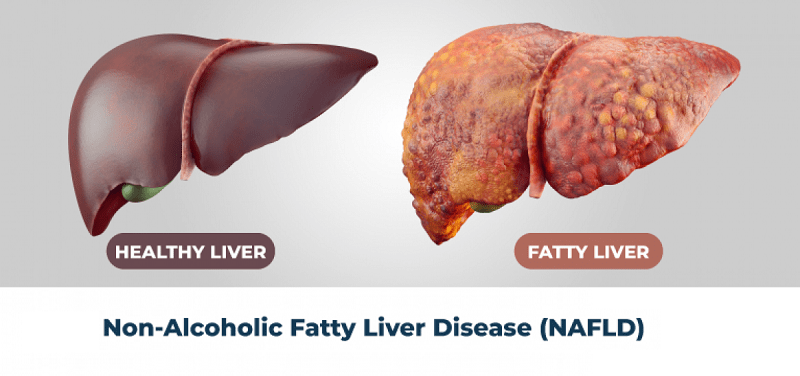 NAFLD