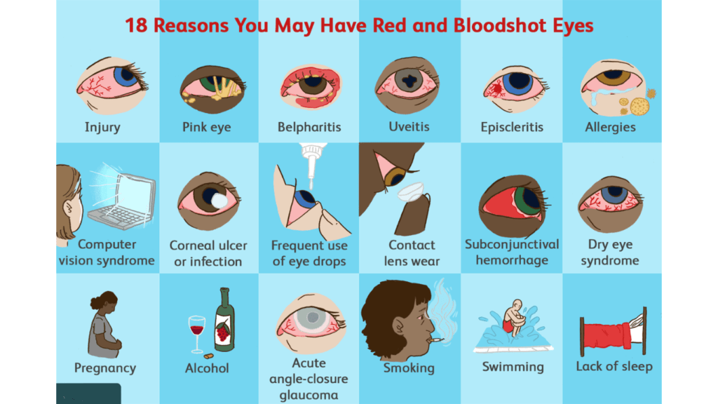 Reasons of red eye