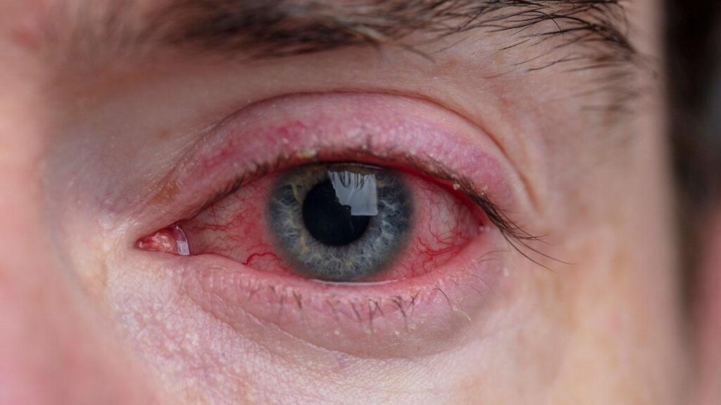 How to Identify Pink Eye