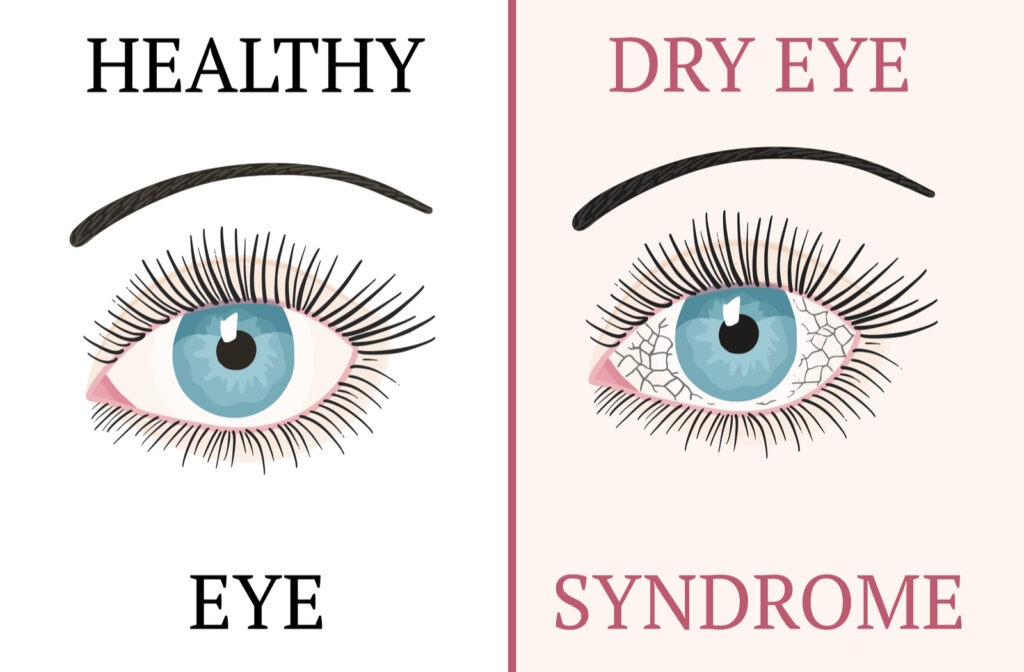 Dry Eye Syndrome