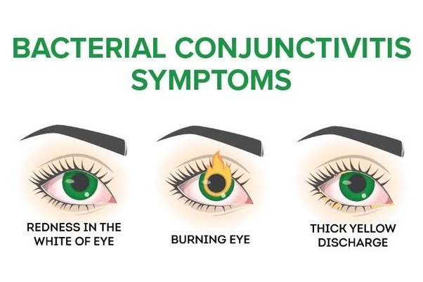 What Is Commonly Misdiagnosed as Pink Eye