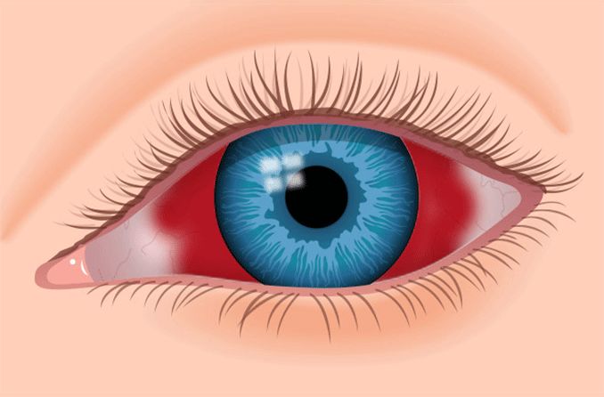 Subconjunctival Hemorrhage