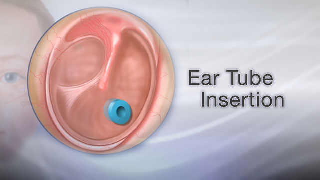 Tympanostomy Tubes