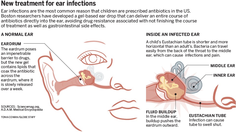 Children More Likely to Get Ear Infections