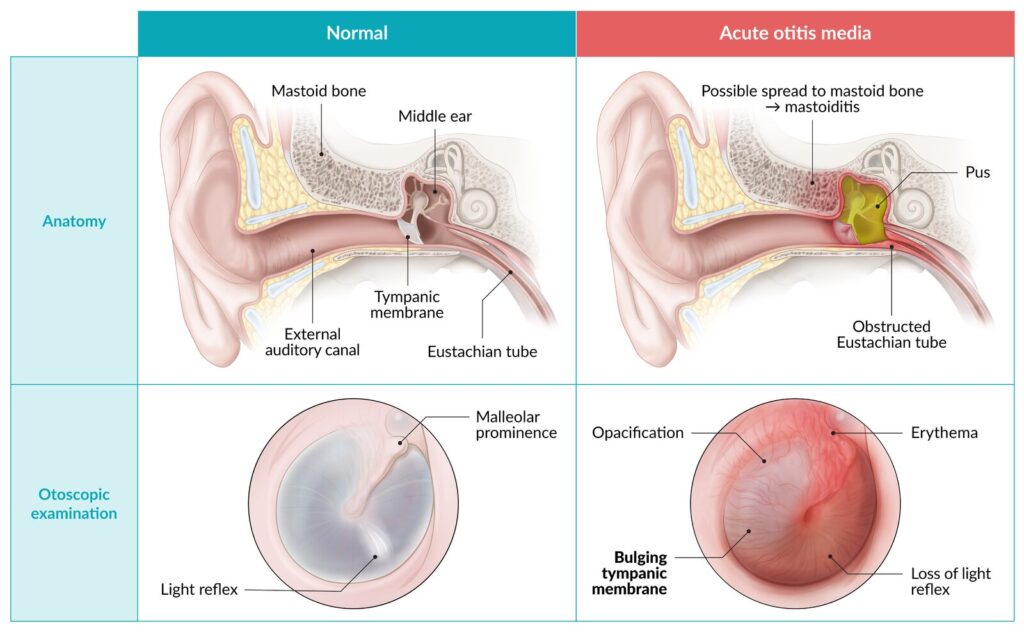 Acute Otitis Media (AOM)