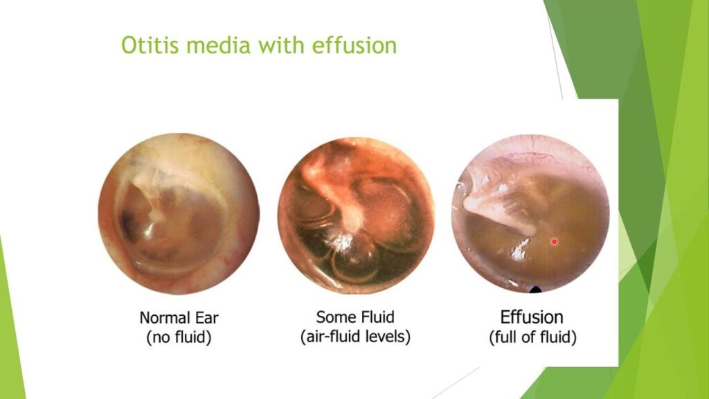 Otitis Media with Effusion (OME)