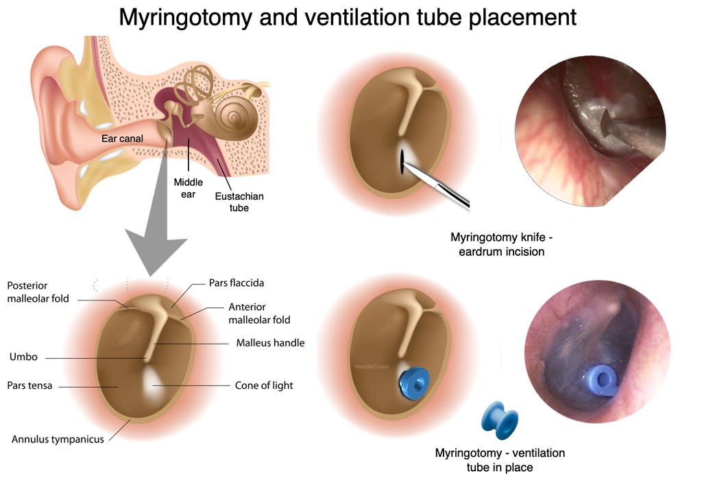 Myringotomy with Tube Insertion