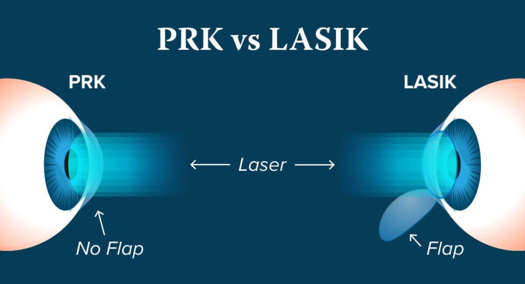 PRK Vs. LASIK