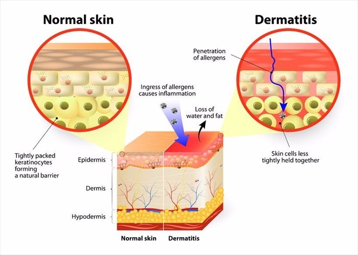 Normal skin Vs. Dermatitis