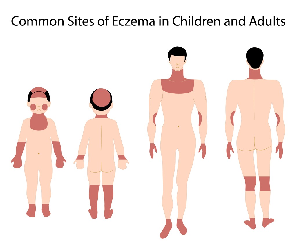 Eczema in children Vs. adults