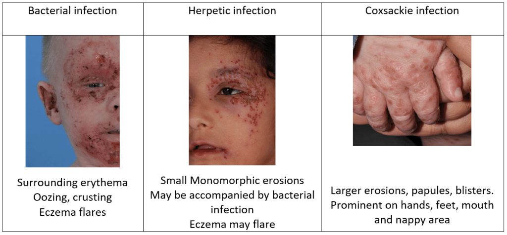 Myths About Papular Dermatitis