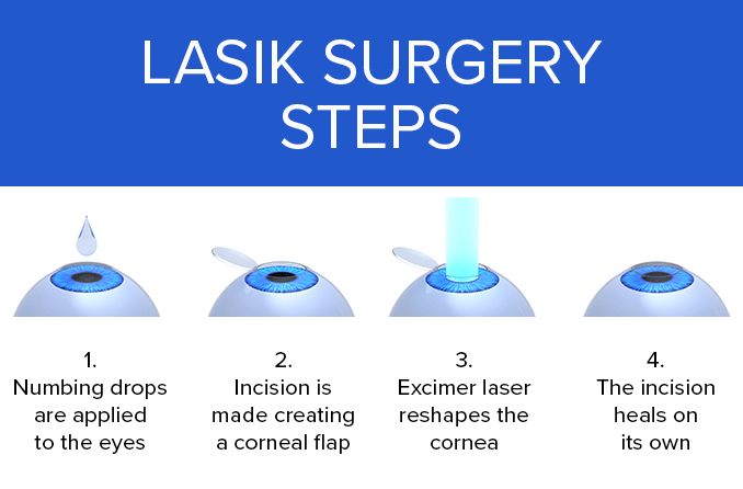 Laser-Assisted In Situ Keratomileusis