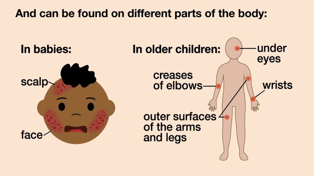 Bumpy Eczema in Children