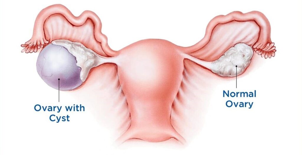 Ovarian Cyst Surgery