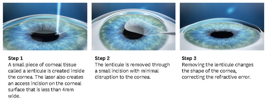 Small Incision Lenticule Extraction