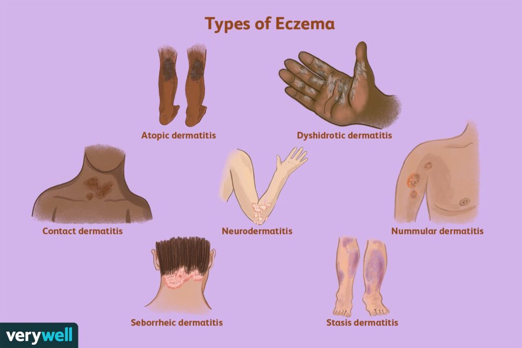 Types of Eczema