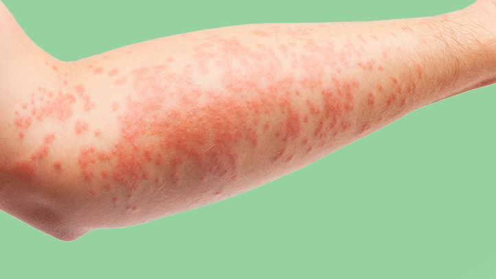 Symptoms of bumpy eczema